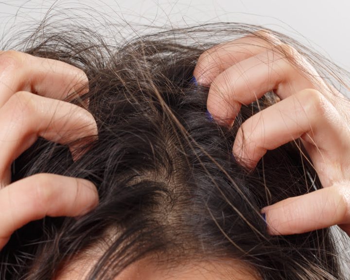 Learn About Effective and Affordable dandruff Scalp Treatment in Singapore