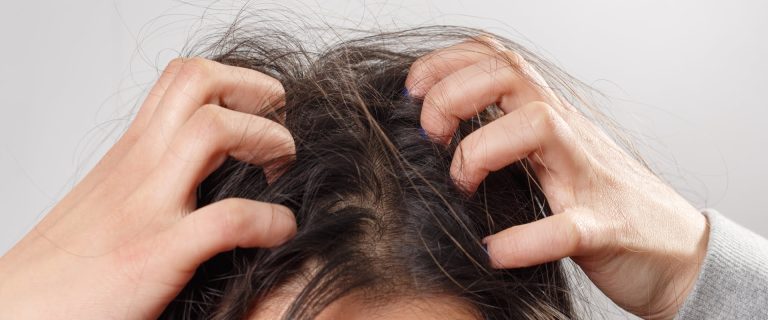 Learn About Effective and Affordable dandruff Scalp Treatment in Singapore